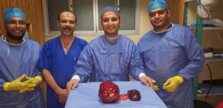 يزن 10كجم..فريق طبي بجامعة أسيوط...