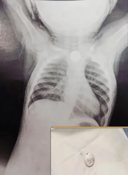 إنقاذ حياة رضيع ابتلع بطارية  بـ «مجمع الأقصر الطبي»